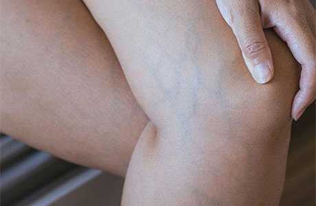 Varicose veins